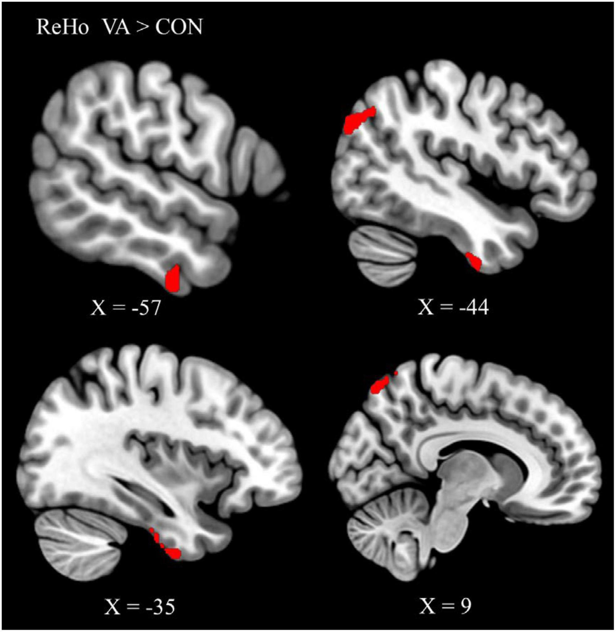 Enhanced intrinsic functional connectivity in the visual system of visual artist: Implications for creativity